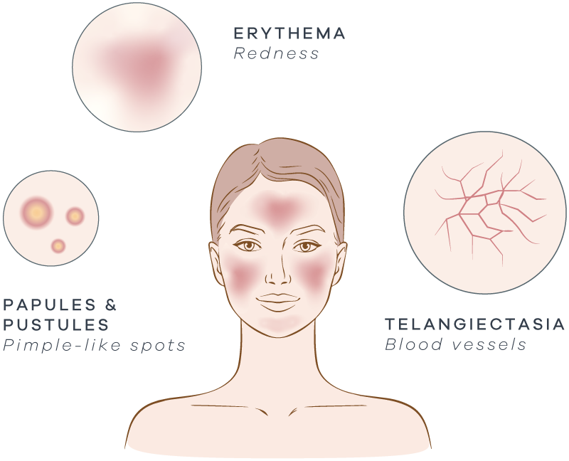 Sypmptoms of rosacea - erythema/redness, papules & pustules, telangiectasia.
